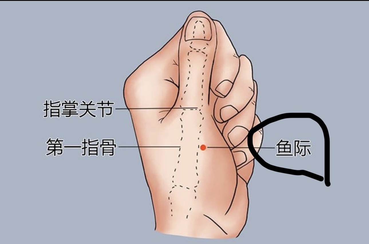 I Sprained my Ankle But Got Acupunctured On my Wrist.